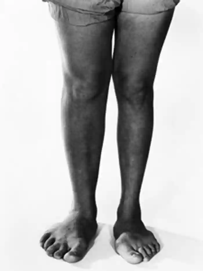 Enlargement of the feet due to pituitary hyperfunction (gigantism).