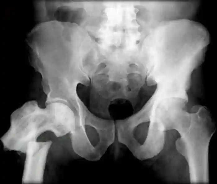 Frontal X-ray of a human pelvis and hips with a severe fracture of the right femur near the hip, caused by Paget&amp;#x27;s disease, which weakens bones and predisposes them to fracture.