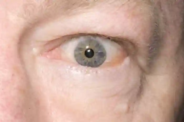 Inflammation of the tissues around the eye of a 58-year-old man with Graves&amp;#x27; thyrotoxicosis.