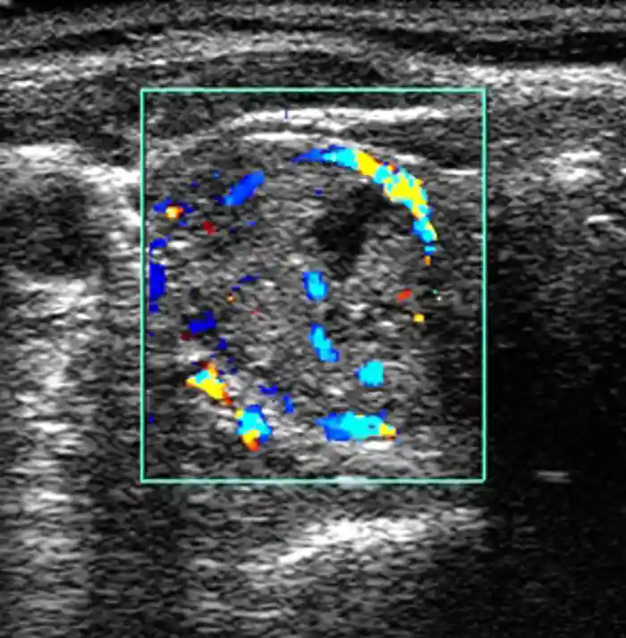 Ultrasound scan in transverse section of the thyroid gland of a 73-year-old female patient, showing a hot nodule (increased activity) in one thyroid lobe corresponding to a toxic <a  tabindex='0' class='popover-dismiss' href='/glossary/a#adenoma' data-target-type='glossary' data-target-url='/glossary/a#adenoma' data-bs-toggle='popover' data-bs-trigger='focus' title='adenoma' data-bs-content='1490' >adenoma</a>.