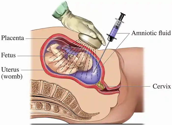 A medical drawing to show the process of <a  tabindex='0' class='popover-dismiss' href='/glossary/a#amniocentesis' data-target-type='glossary' data-target-url='/glossary/a#amniocentesis' data-bs-toggle='popover' data-bs-trigger='focus' title='amniocentesis' data-bs-content='1495' >amniocentesis</a>, which can be carried out during pregnancy. A fine needed is used to take a sample of amniotic fluid from the mother&amp;#x27;s uterus (womb), which is then analysed to determine the karyotype (chromosome arrangement) of the fetus.