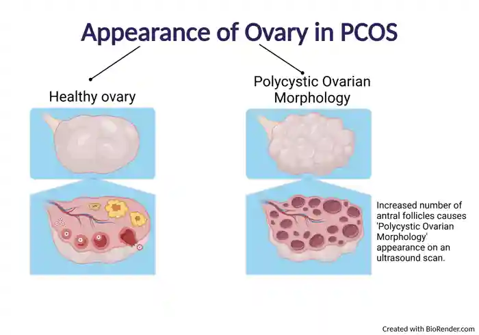 Figure 2. Representation of the appearance of Polycystic Ovarian Morphology on an ultrasound scan.