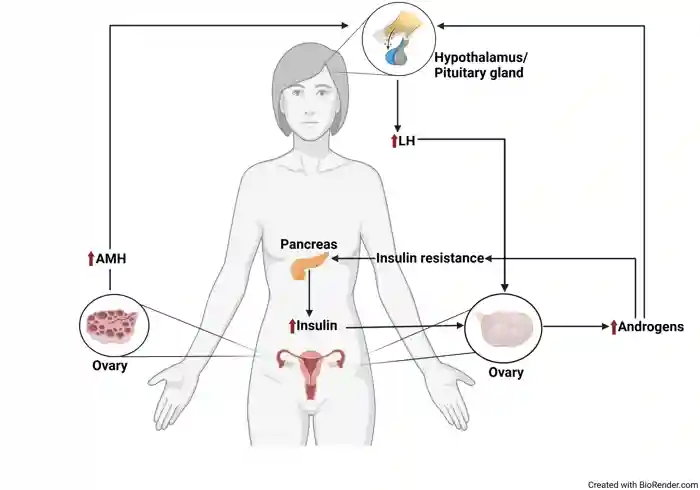 Figure 3. Diagram showing the mechanism of PCOS. Abbreviations: LH, luteinising hormone; <a  tabindex='0' class='popover-dismiss' href='/hormones/anti-muellerian-hormone/' data-target-type='infoSheet' data-target-url='/hormones/anti-muellerian-hormone/' data-bs-toggle='popover' data-bs-trigger='focus' title='AMH' data-bs-content='1440' >AMH</a>, anti-Mϋllerian hormone.