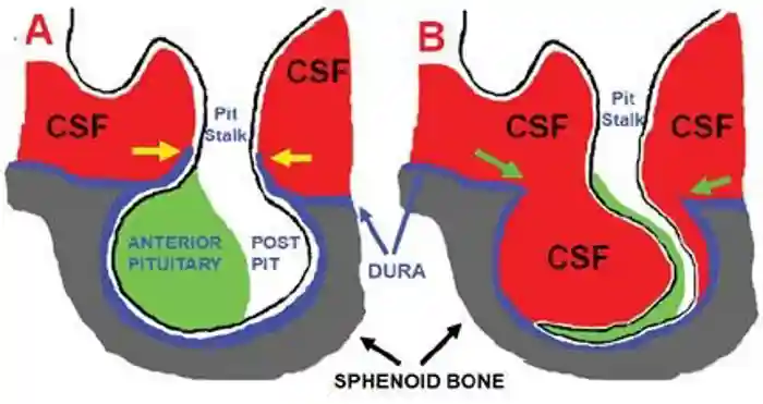 Empty sella syndrome